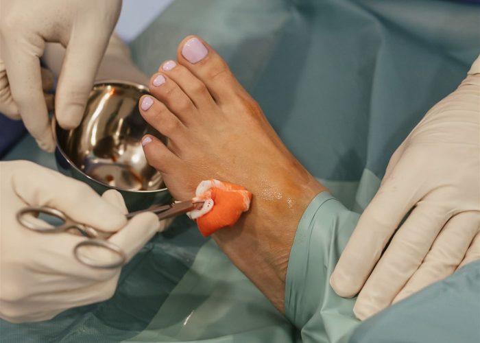 Podólogos obteniendo una biopsia de tejido del pie